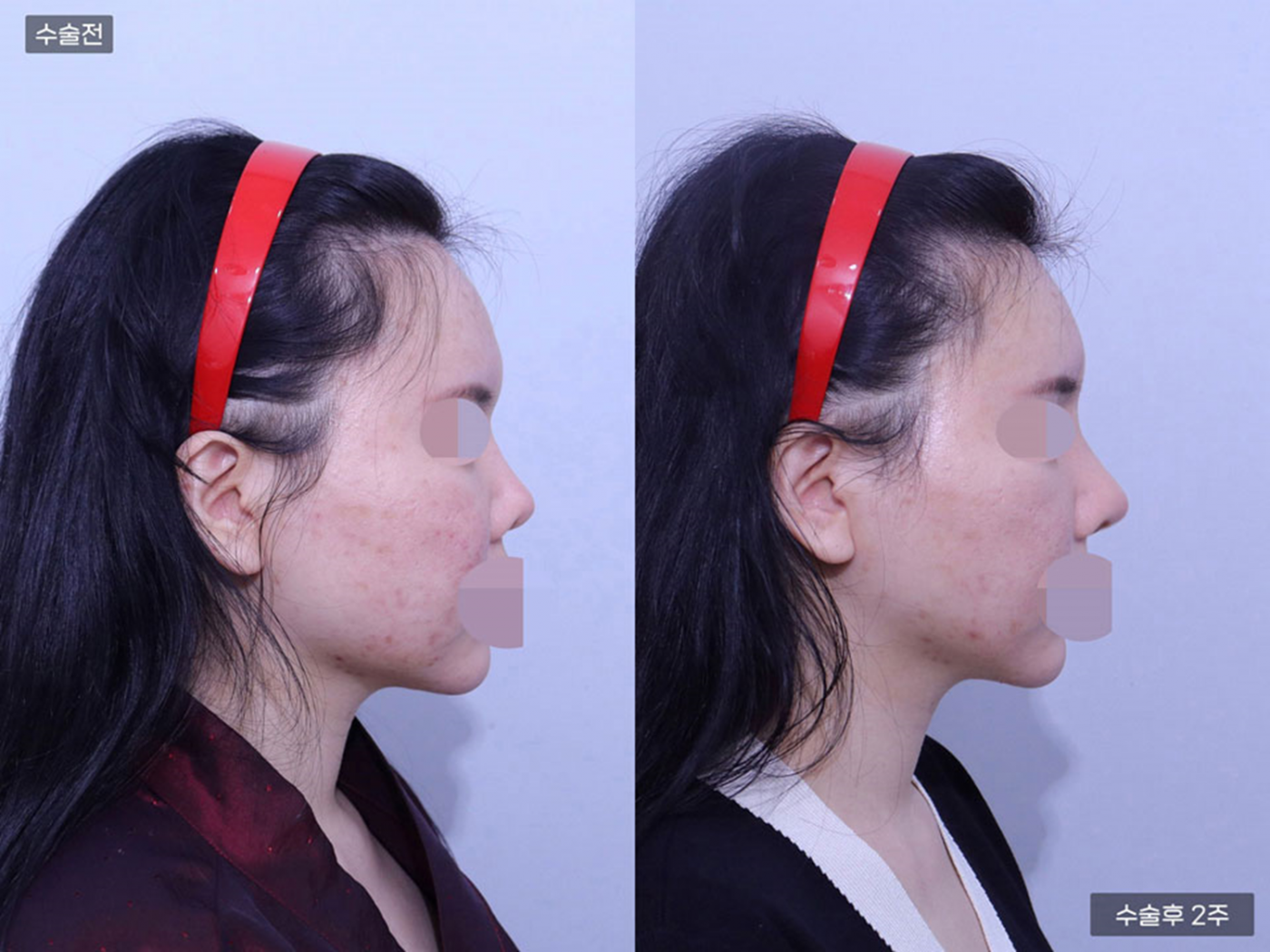 코재수술 + 복코 + 매부리코 + 비공내리기