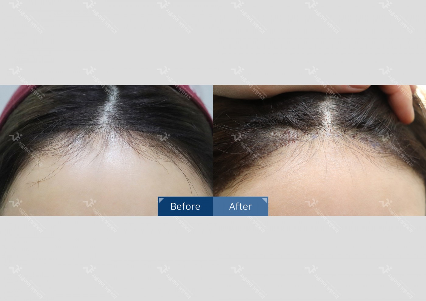 모발이식 [절개 모발이식(2000모)]