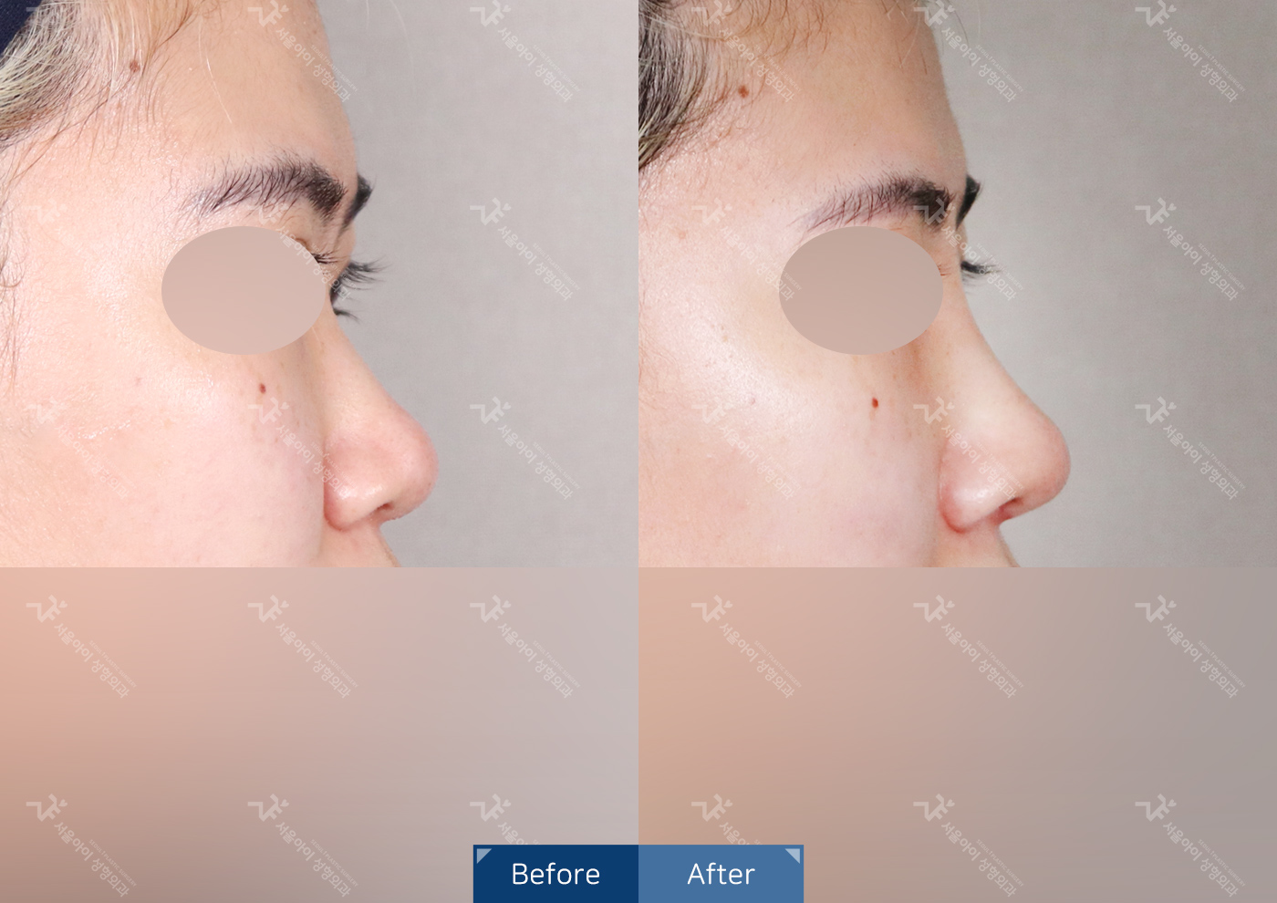 코성형[기능2종 + 미용코]