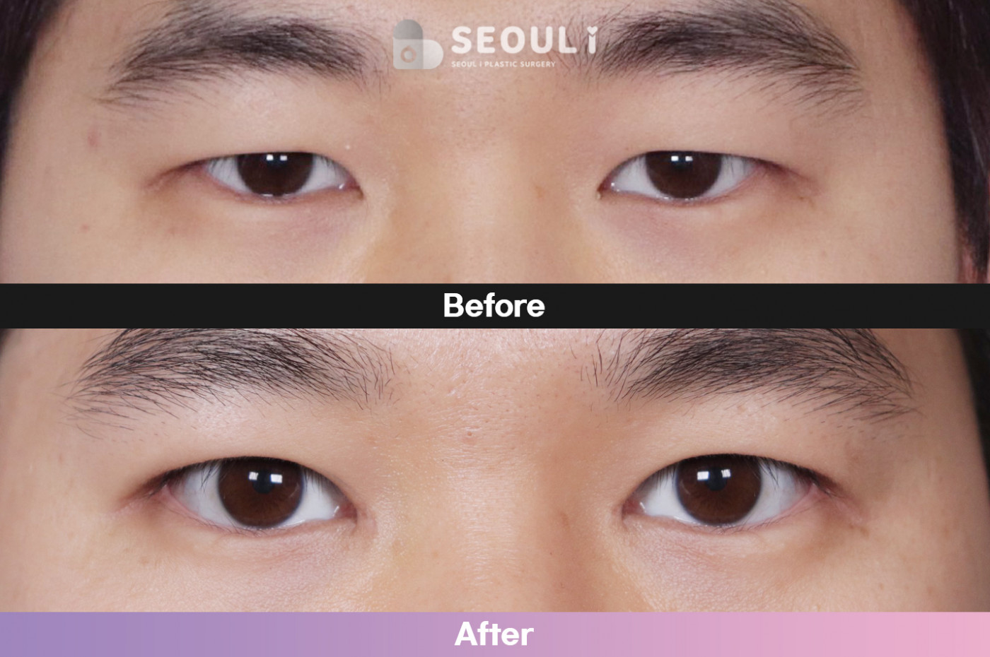 눈성형 [자연유착 쌍꺼풀 + 앞트임 + 눈매교정]