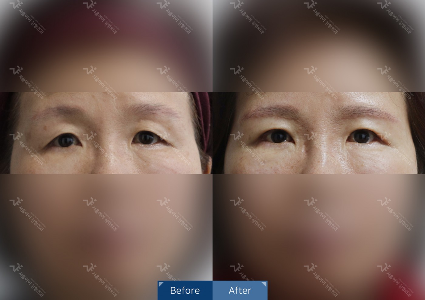 눈성형 [눈썹하거상술]