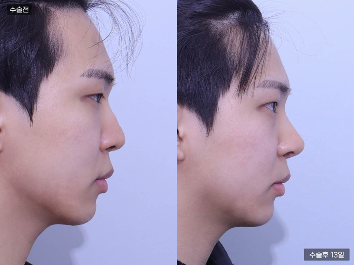 코끝(비중격) + 복코 + 매부리코 + 콧볼축소