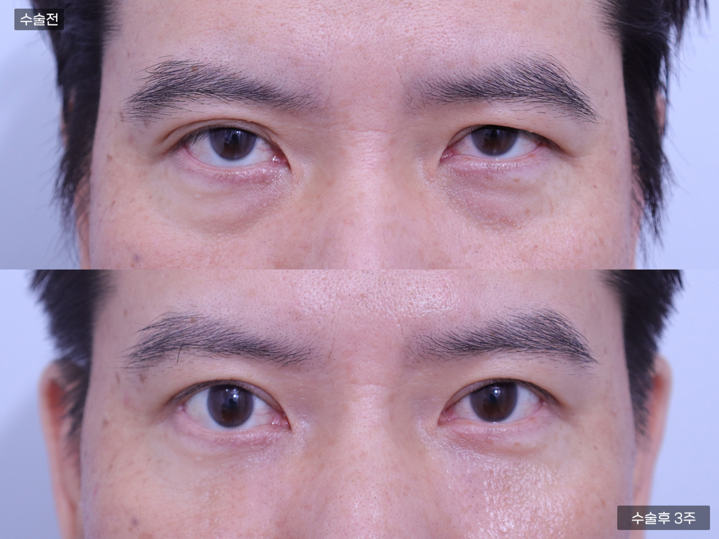 눈성형 [자연유착 쌍꺼풀 + 눈밑지방재배치]