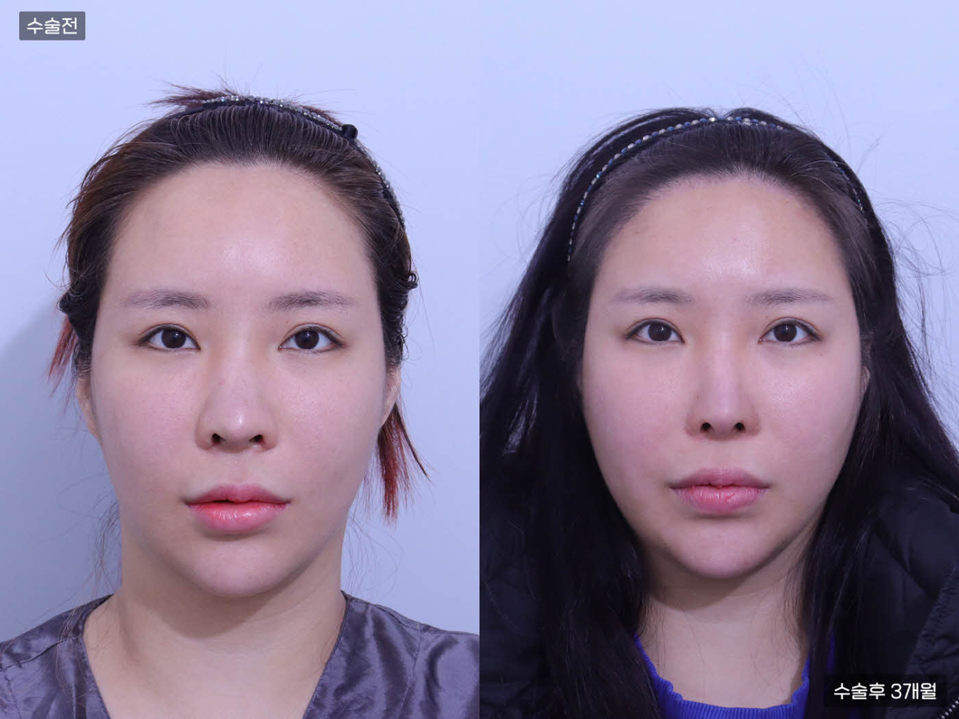 모발이식[비절개 모발이식(3000모)]