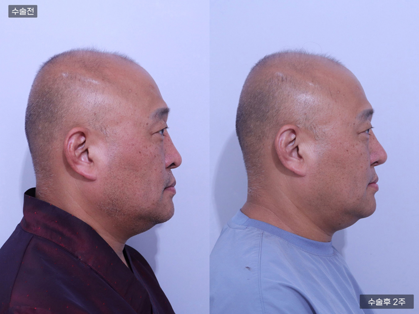 코끝 + 복코 + 매부리코 + 콧볼축소