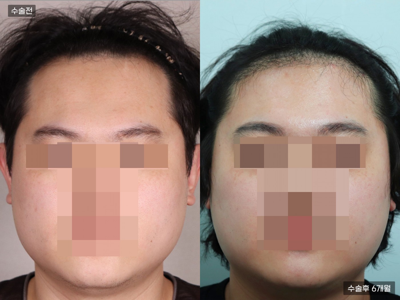 모발이식 [비절개 모발이식(6000모)]