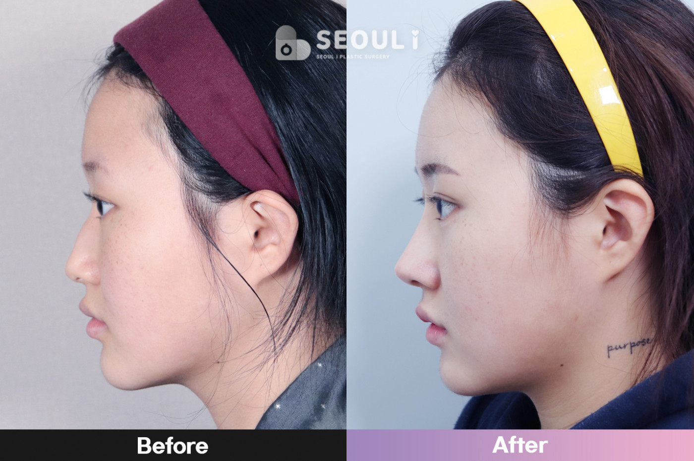 코끝(비중격) + 콧볼 축소술 + 매부리 교정
