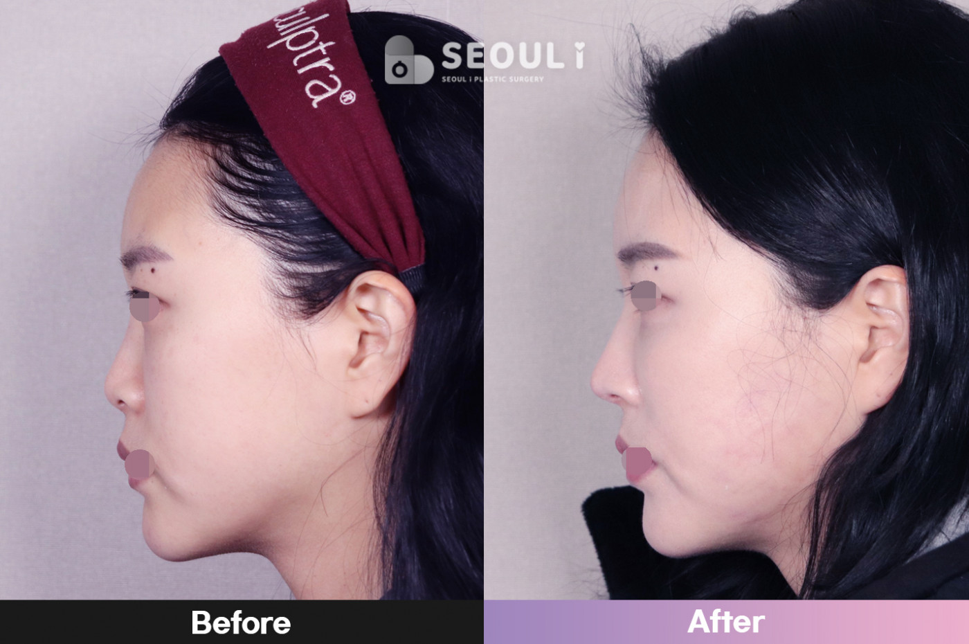 코끝(비중격) + 콧볼 축소술 + 매부리 교정