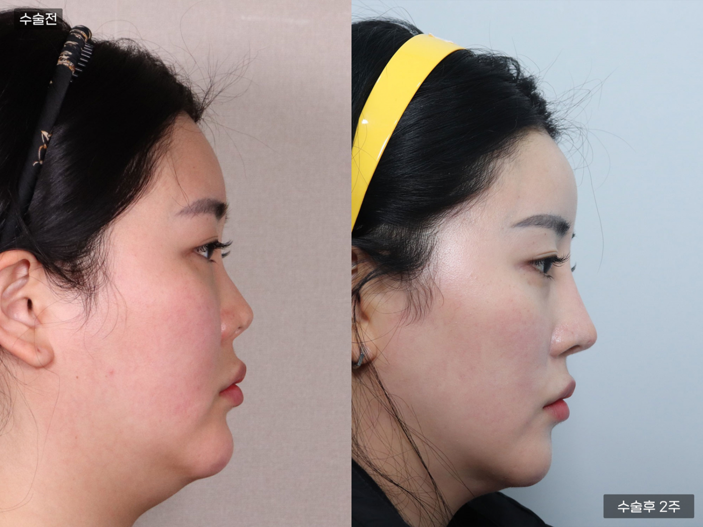 짧은코 + 복코 + 매부리코 + 코끝(비중격)