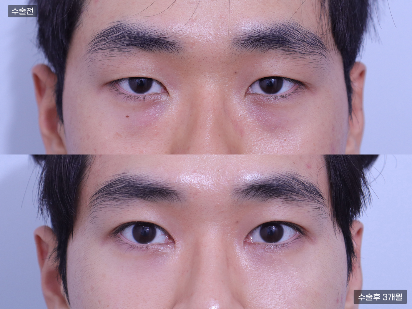 눈성형 [자연유착 쌍꺼풀 + 앞트임 + 눈밑지방재배치]