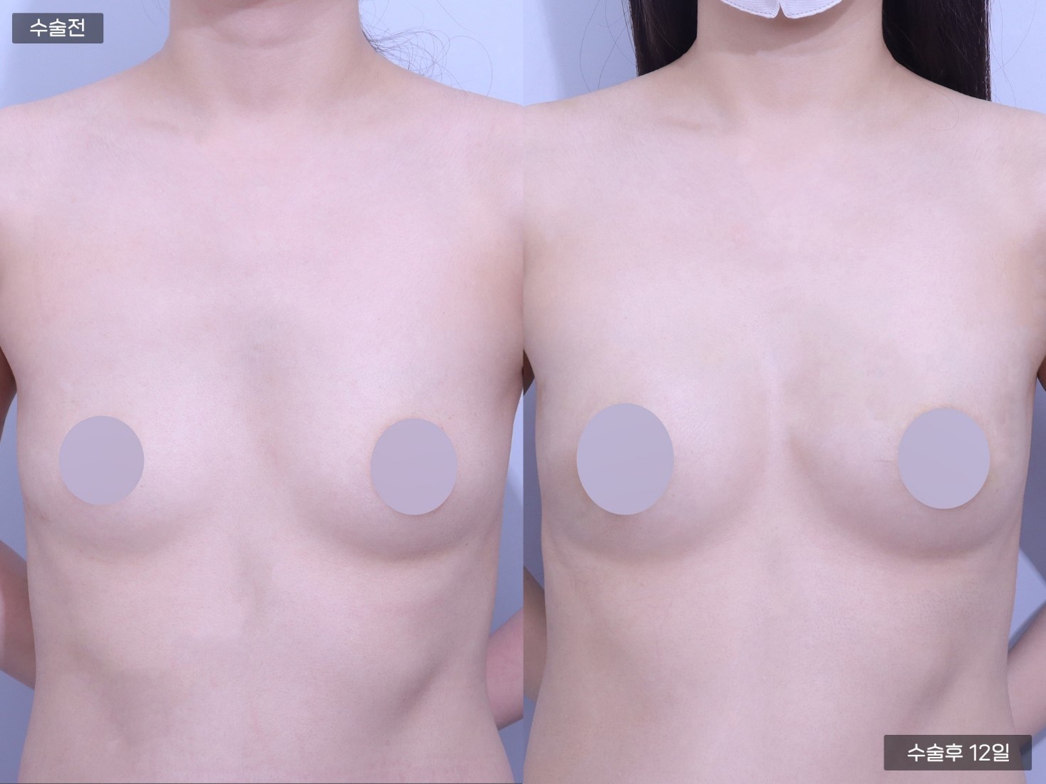 줄기세포 가슴지방이식 (200cc+200cc)