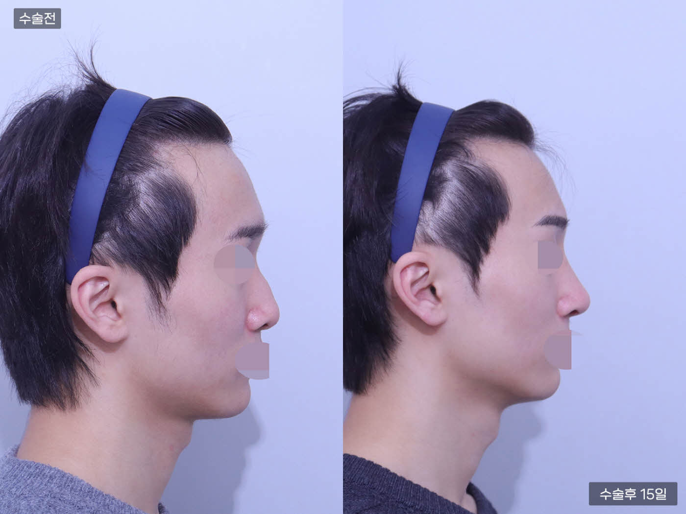 코끝교정 + 매부리코