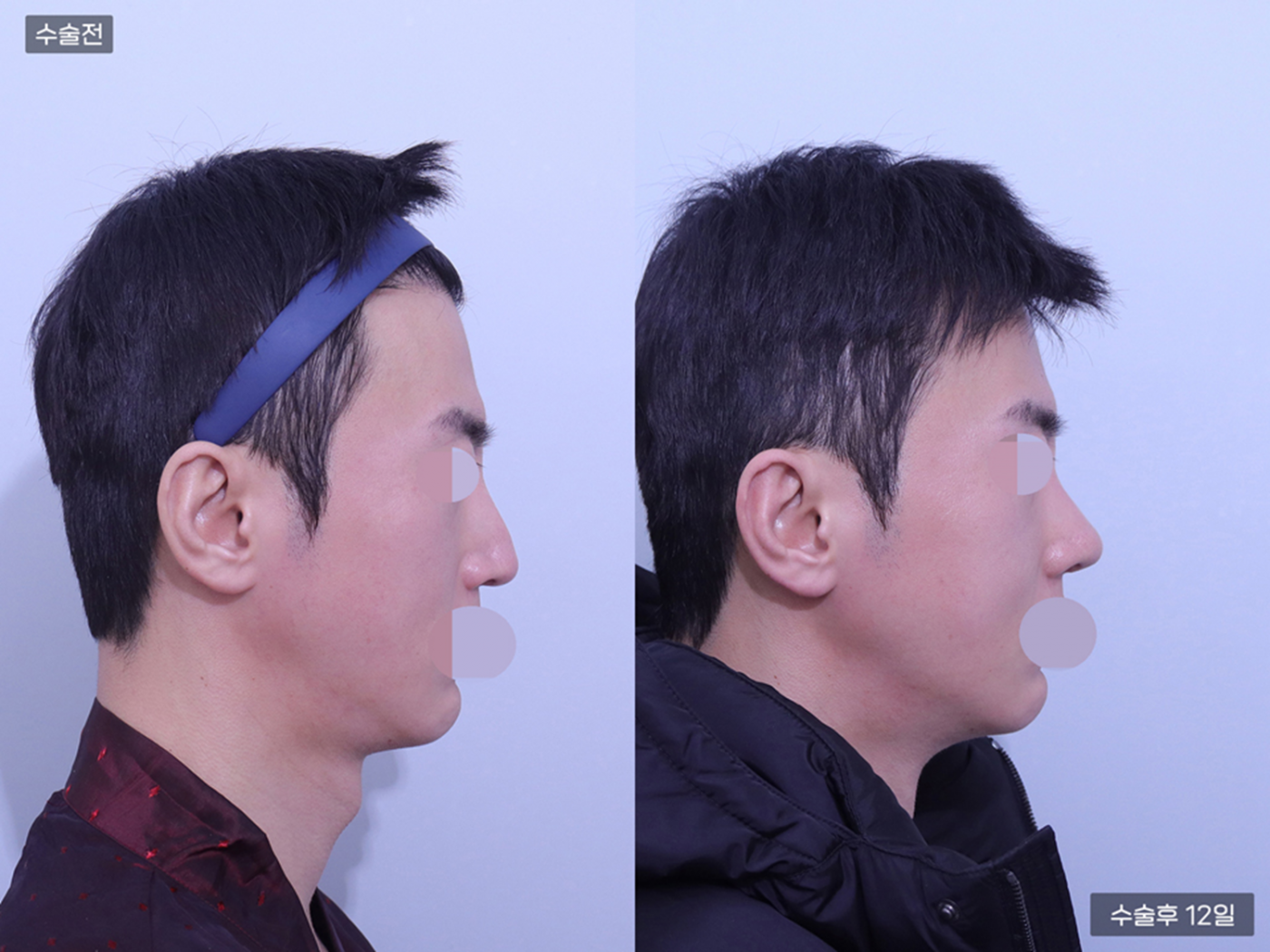 코재수술 + 코끝 + 매부리코