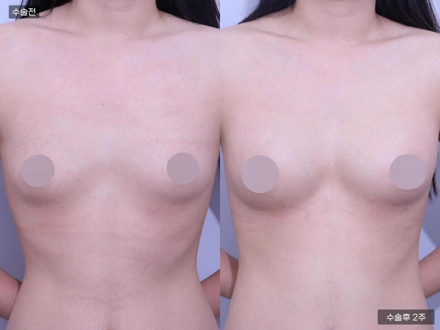 가슴성형 [가슴지방이식(200CC + 200CC)]