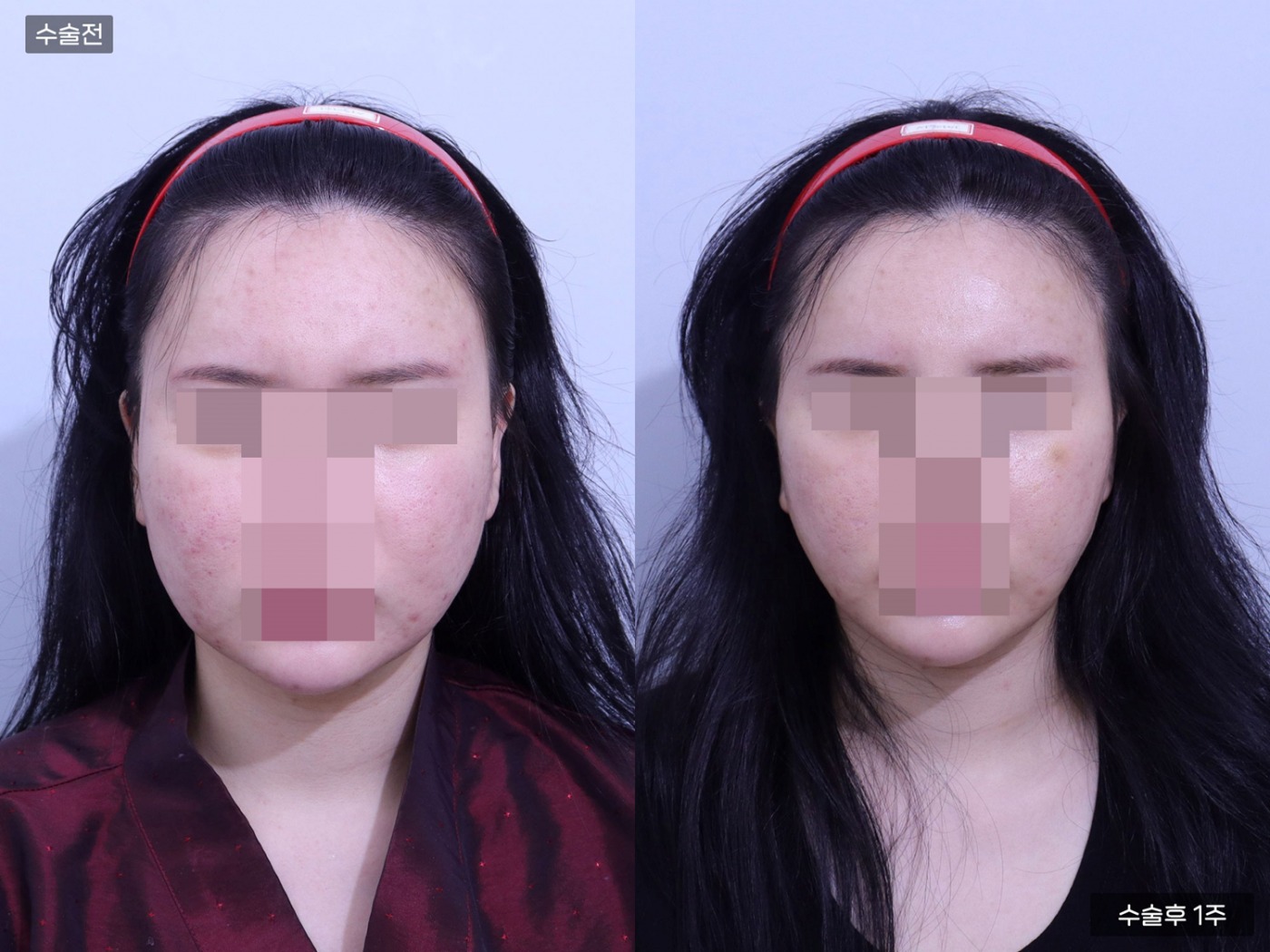 리프팅 [실리프팅]