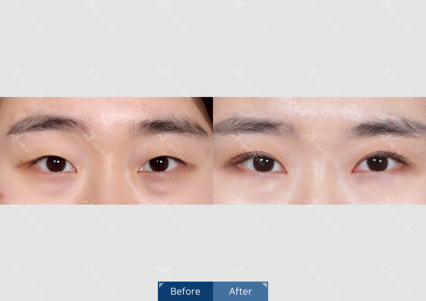 눈성형 [자연유착 쌍꺼풀]