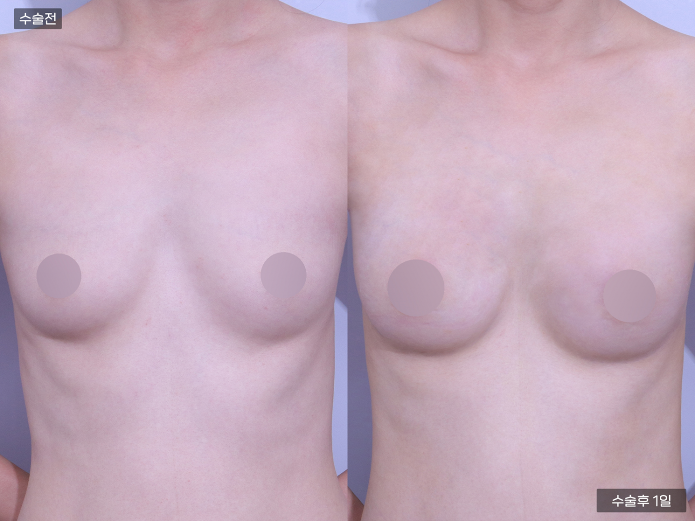 가슴성형 [가슴지방이식(250CC + 250CC)]