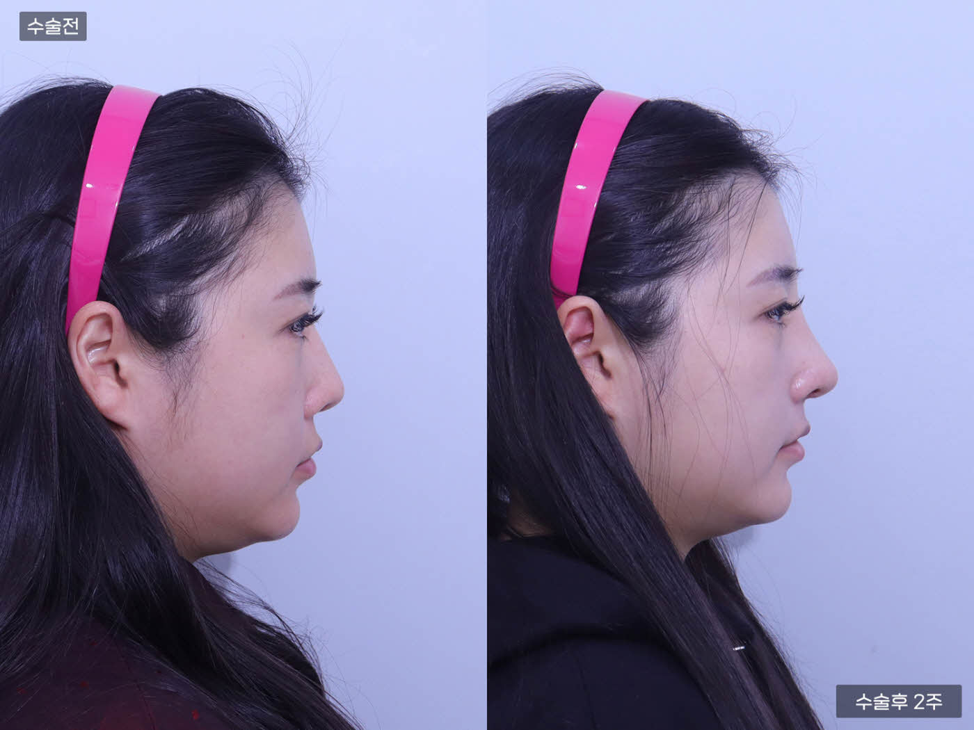 코재수술 + 코끝 + 복코 + 매부리코 + 콧볼축소 + 비주내리기