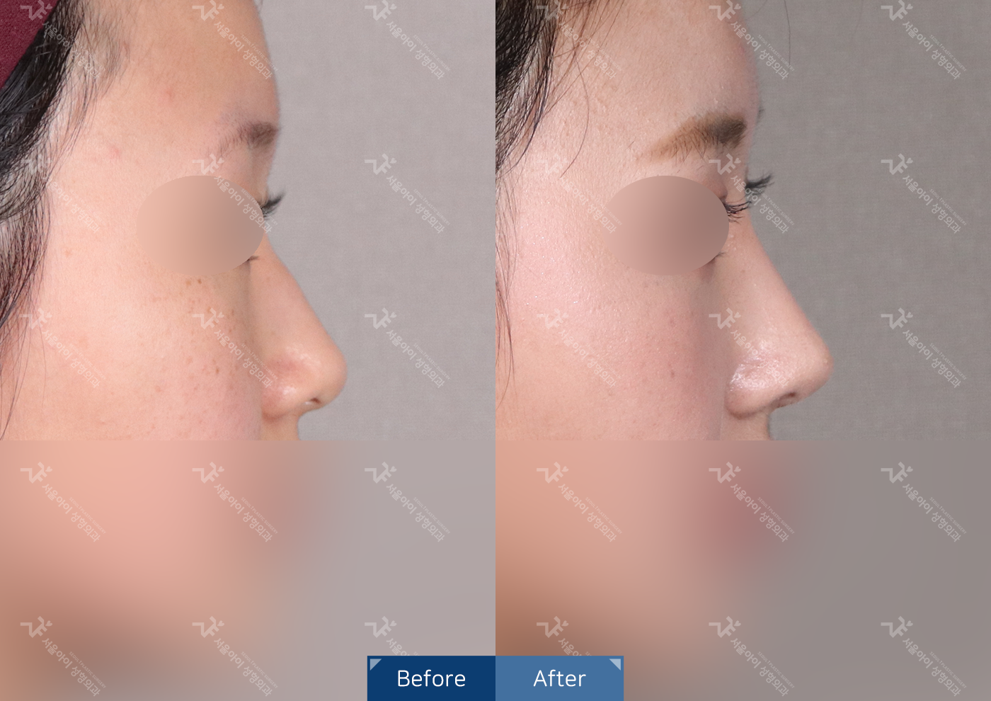 코성형[기능3종 + 미용]