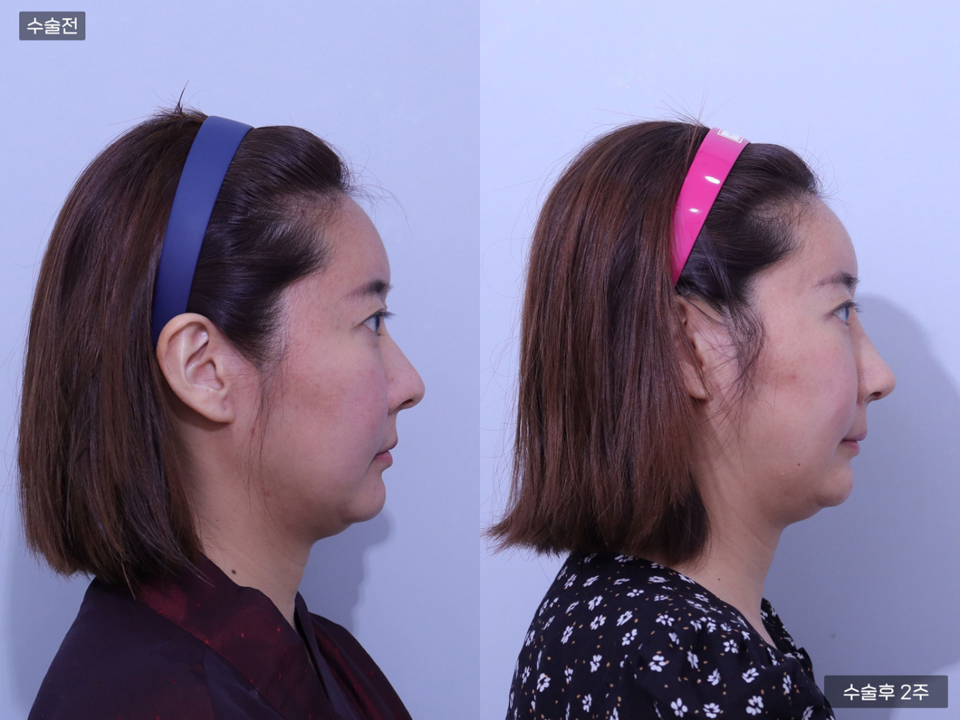 코끝(비중격) + 복코교정 + 비공내리기