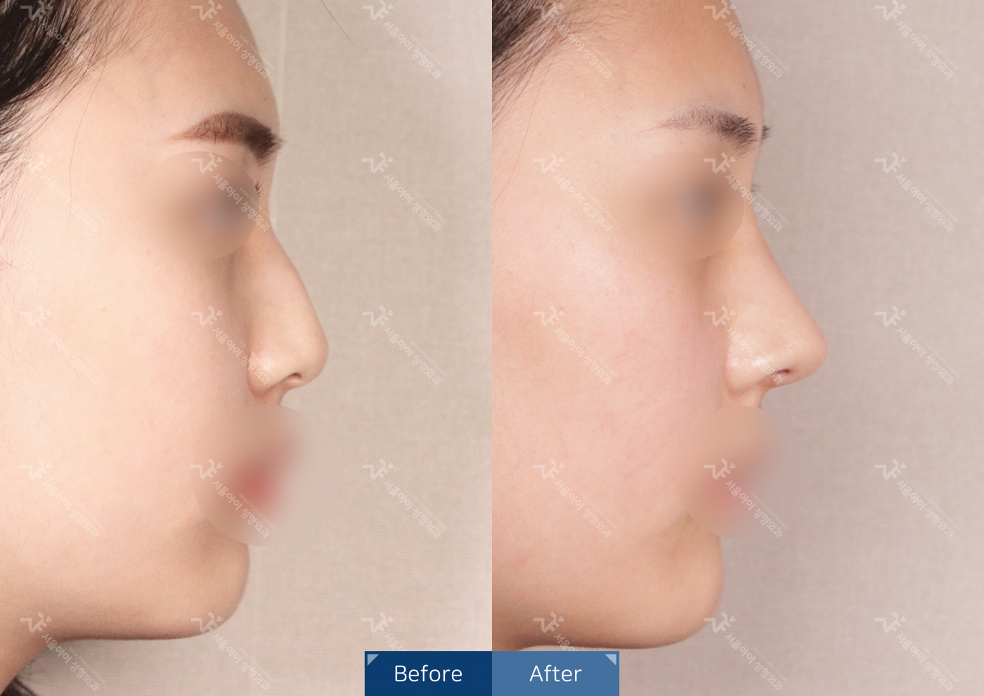 코성형 [코끝조각술+비중격+복코+메부리코]