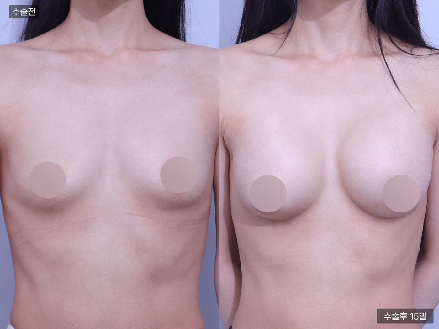 가슴성형 [내추럴가슴보형물]