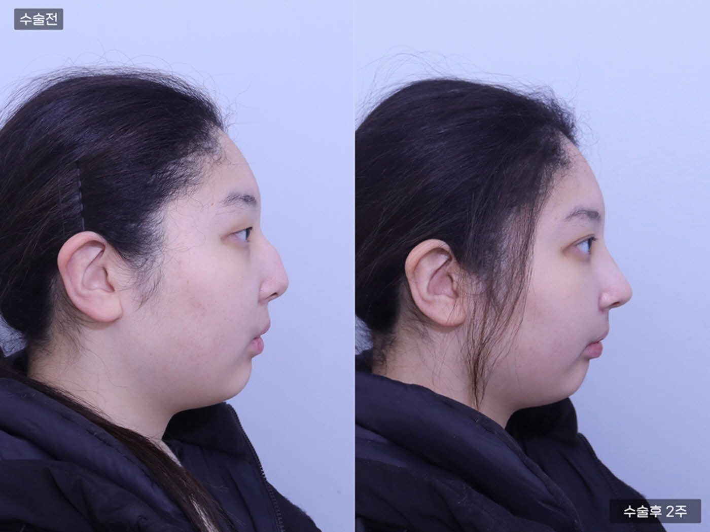 코끝 + 매부리코 + 복코 + 비공내리기 + 자연유착 + 앞트임 + 눈위지방제거