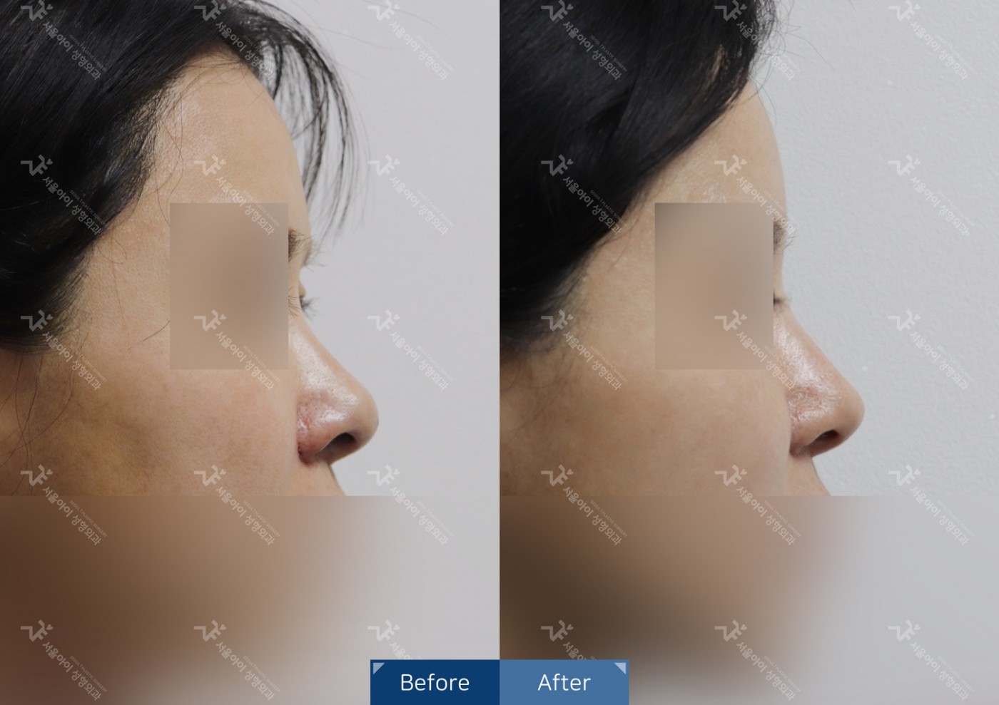 코성형 [비절개콧볼축소+하이코]