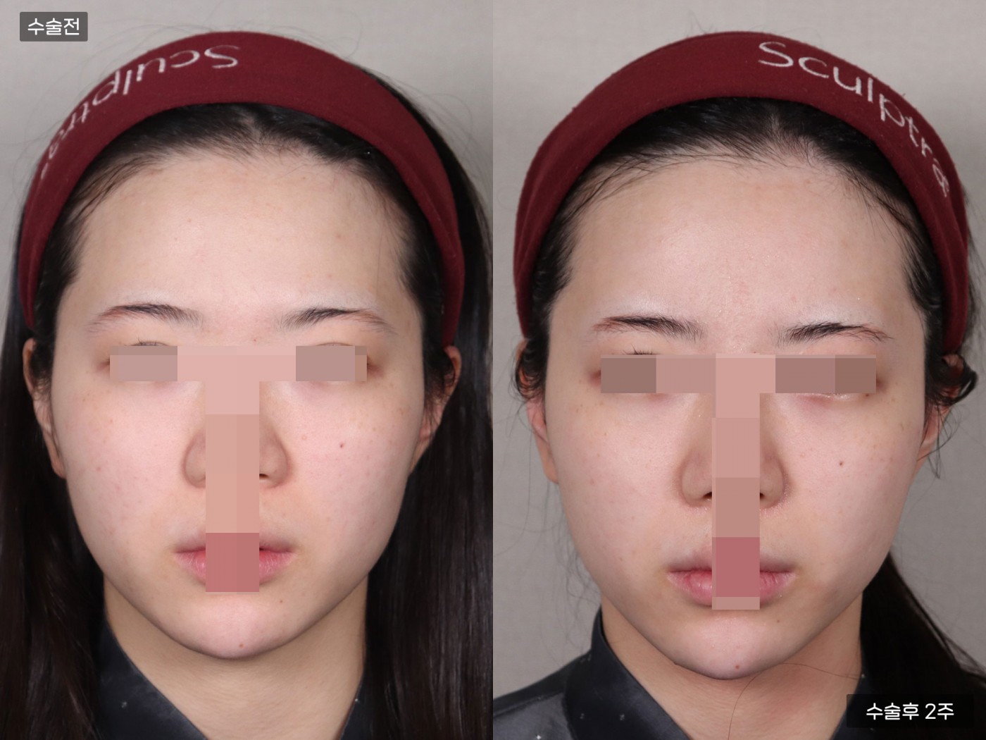 지방이식 [풀페이스]