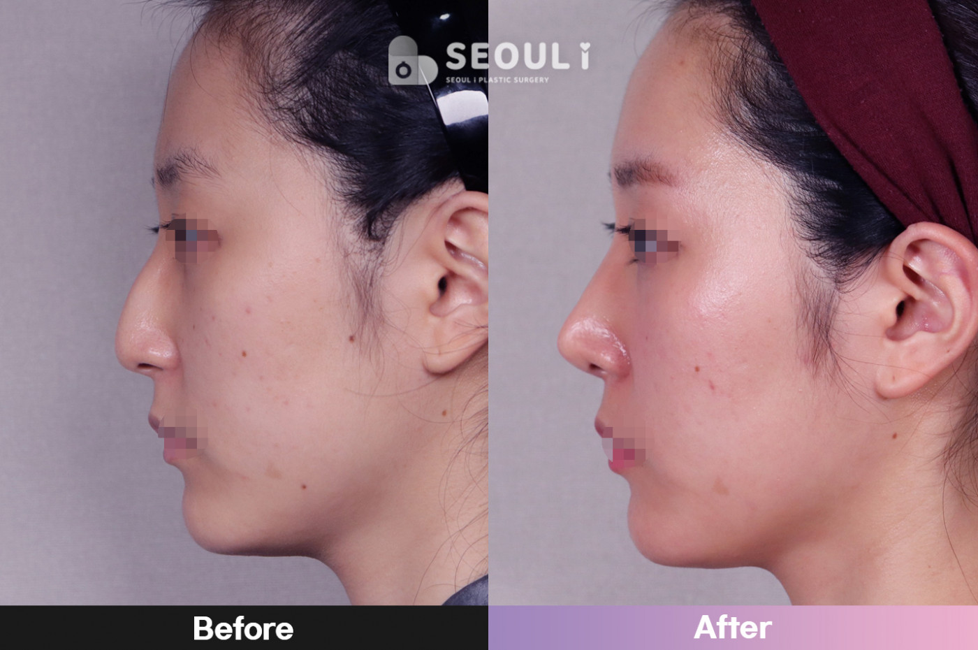 코끝(비중격) + 매부리 교정