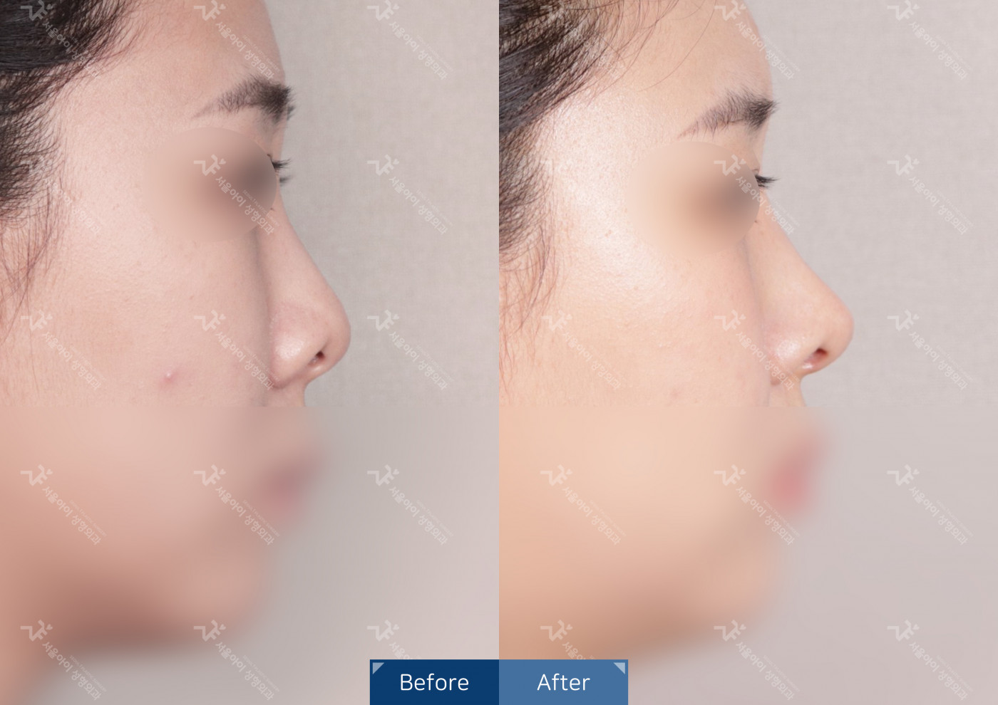 코성형[코끝조각술+비중격+복코교정술+짧은코교정]