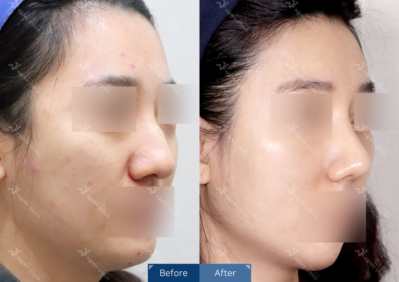 리프팅 [미니리프팅 + 필러]