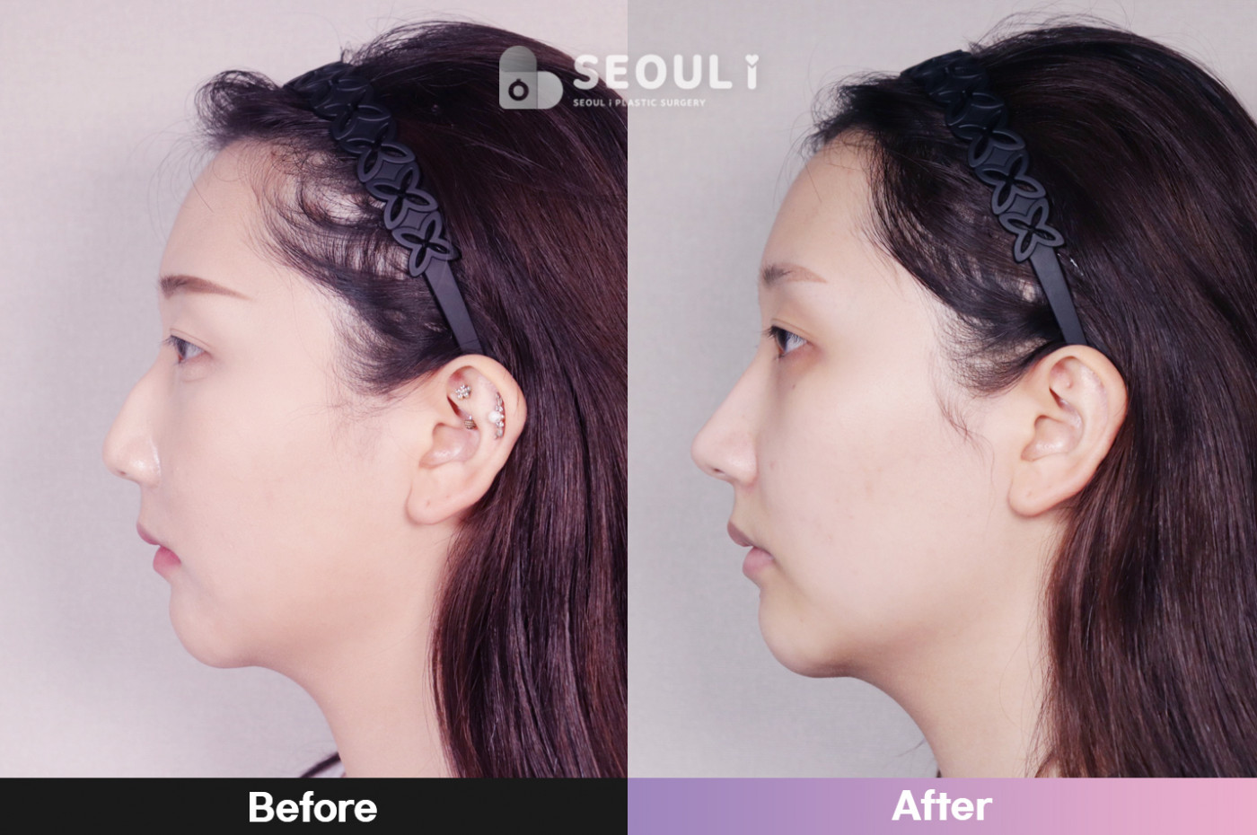 코끝(비중격) + 콧볼 축소술 + 매부리 교정