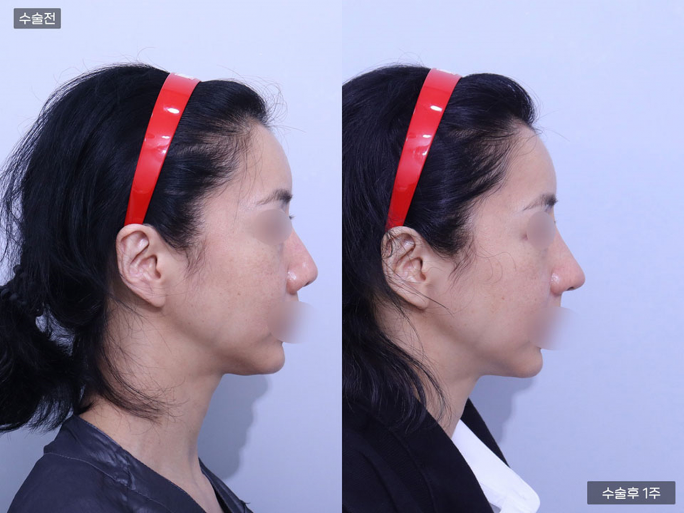 비공내리기 + 복코 + 콧볼축소