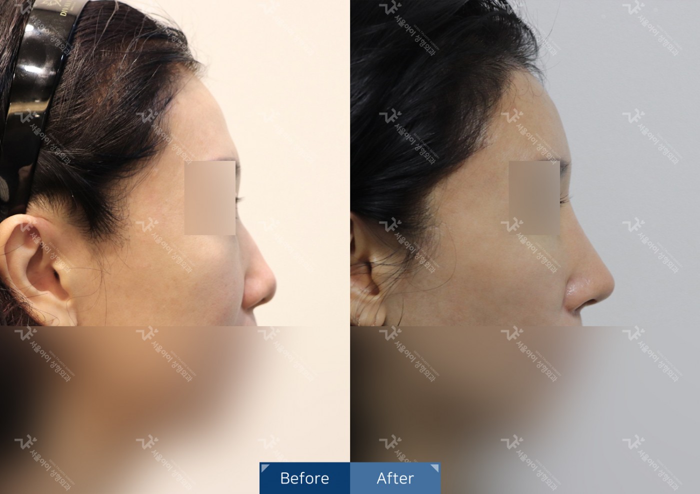 코성형 [융비술+코끝조각술+복코교정술]