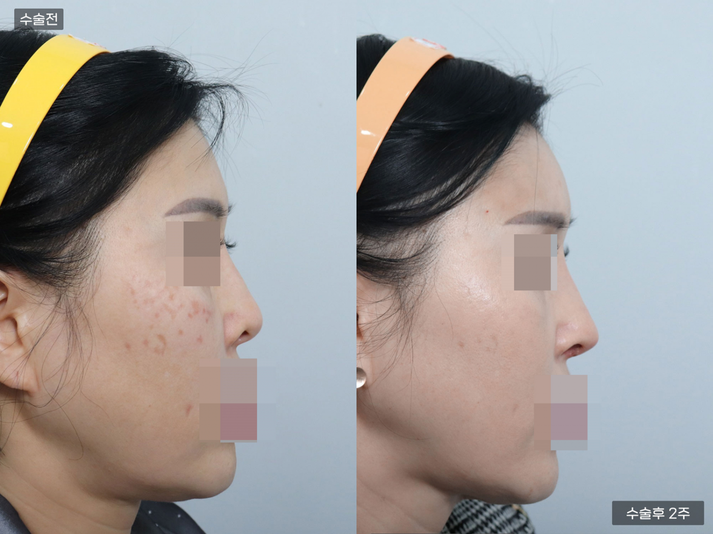 비공내리기 + 복코 + 매부리코