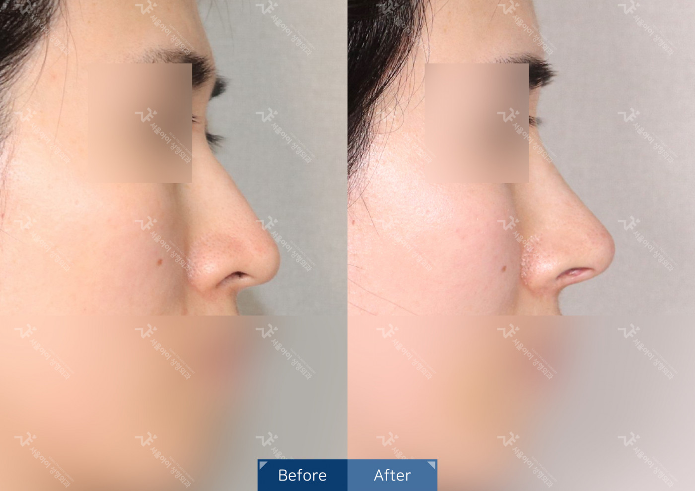 코성형 [코끝조각술(비중격)+복코교정+매부리코교정]