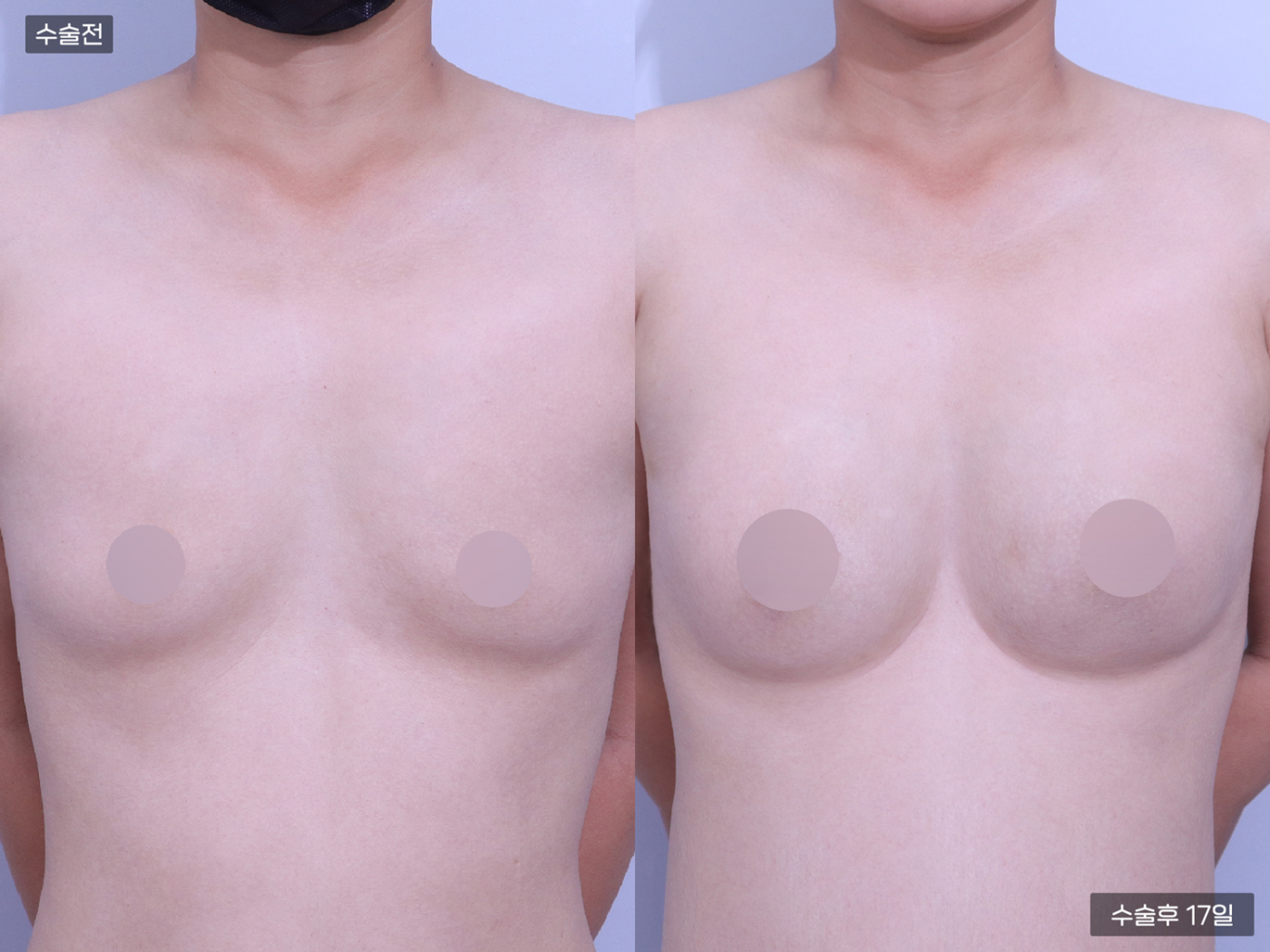 가슴성형 [가슴지방이식(250CC + 250CC)]