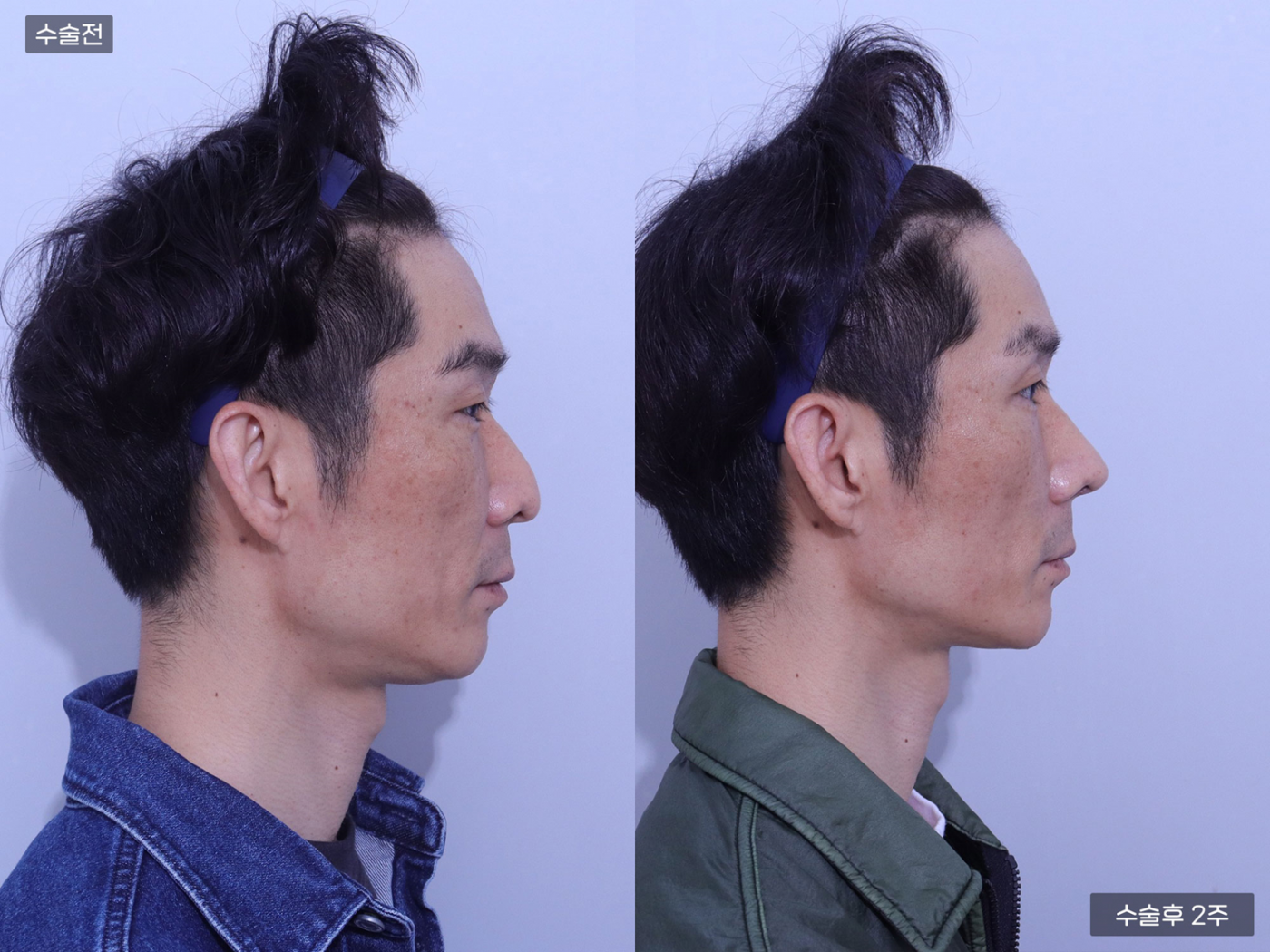 매부리코 + 복코