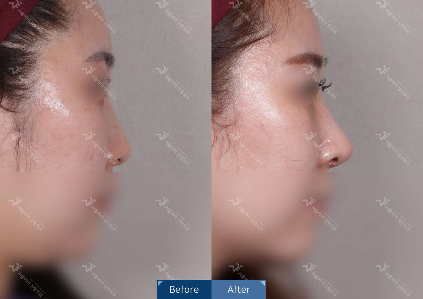 코성형[코끝조각술+비중격+복코교정술+짧은코교정]