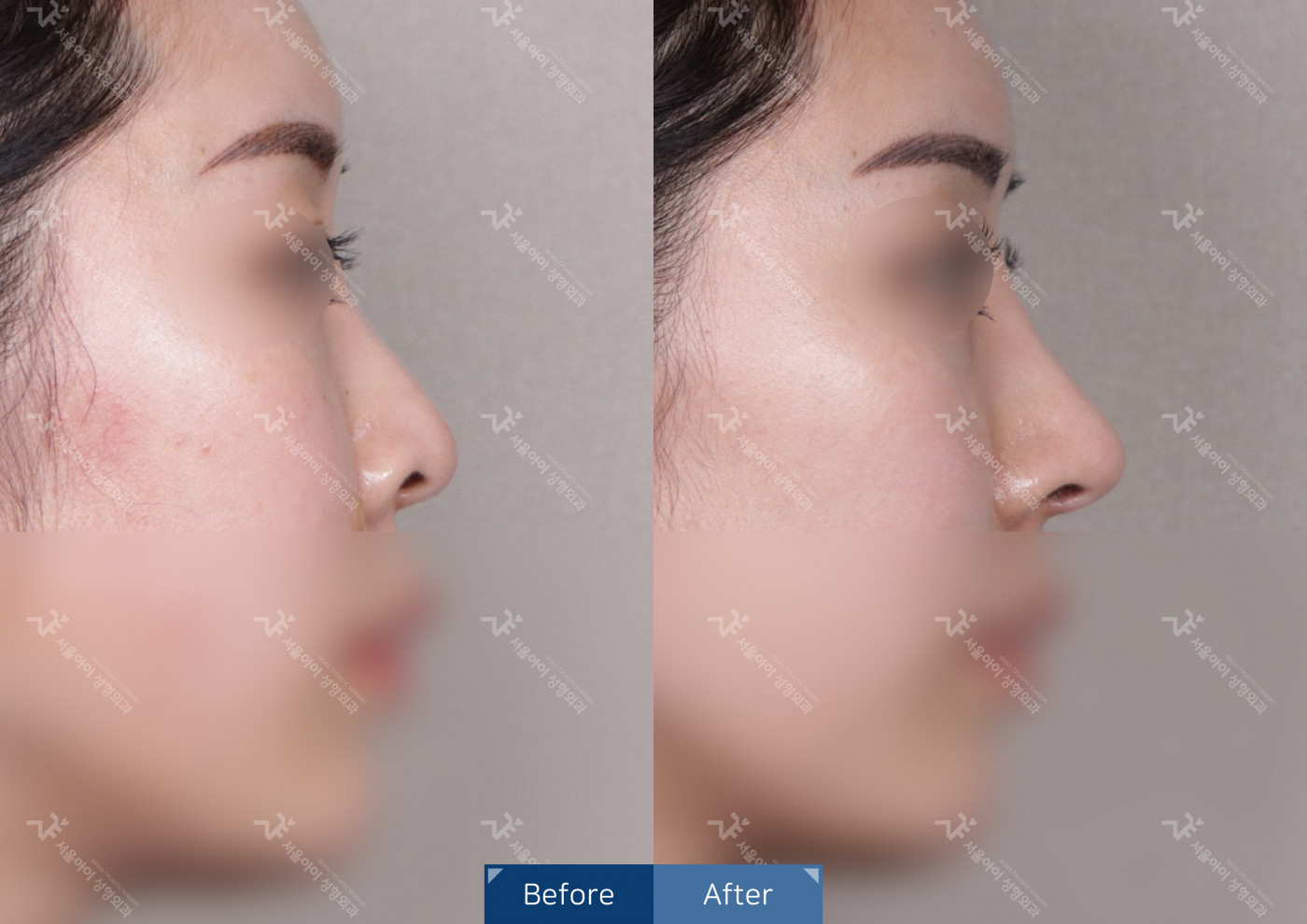 코성형 [융비술&코끝조각술(비중격)+복코교정술+메부리코]