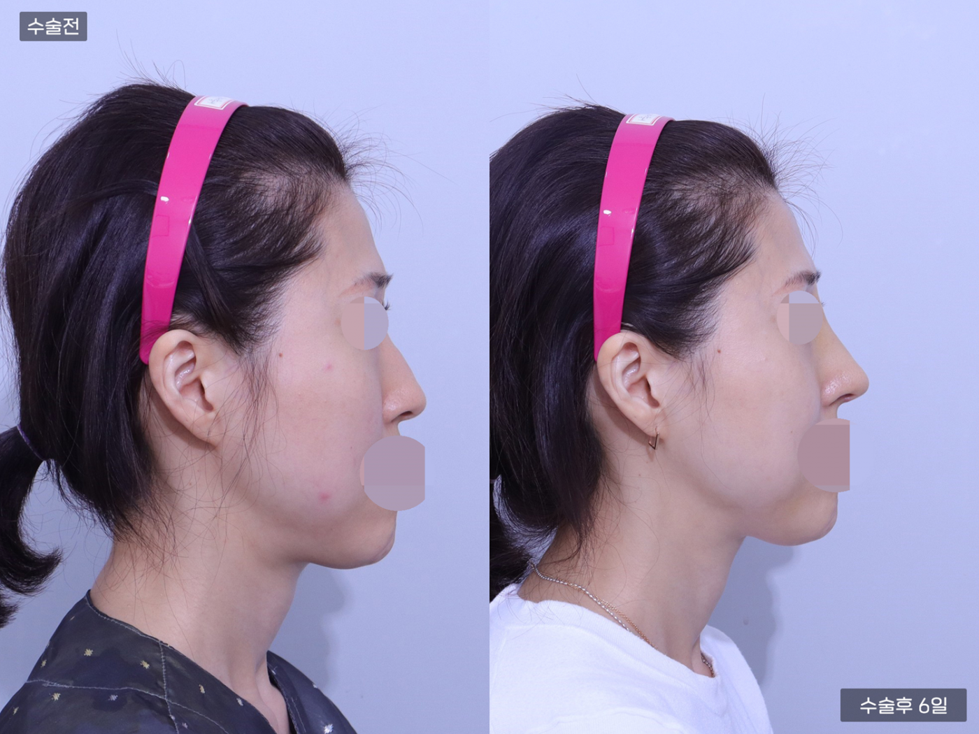 코끝 + 복코 + 매부리코