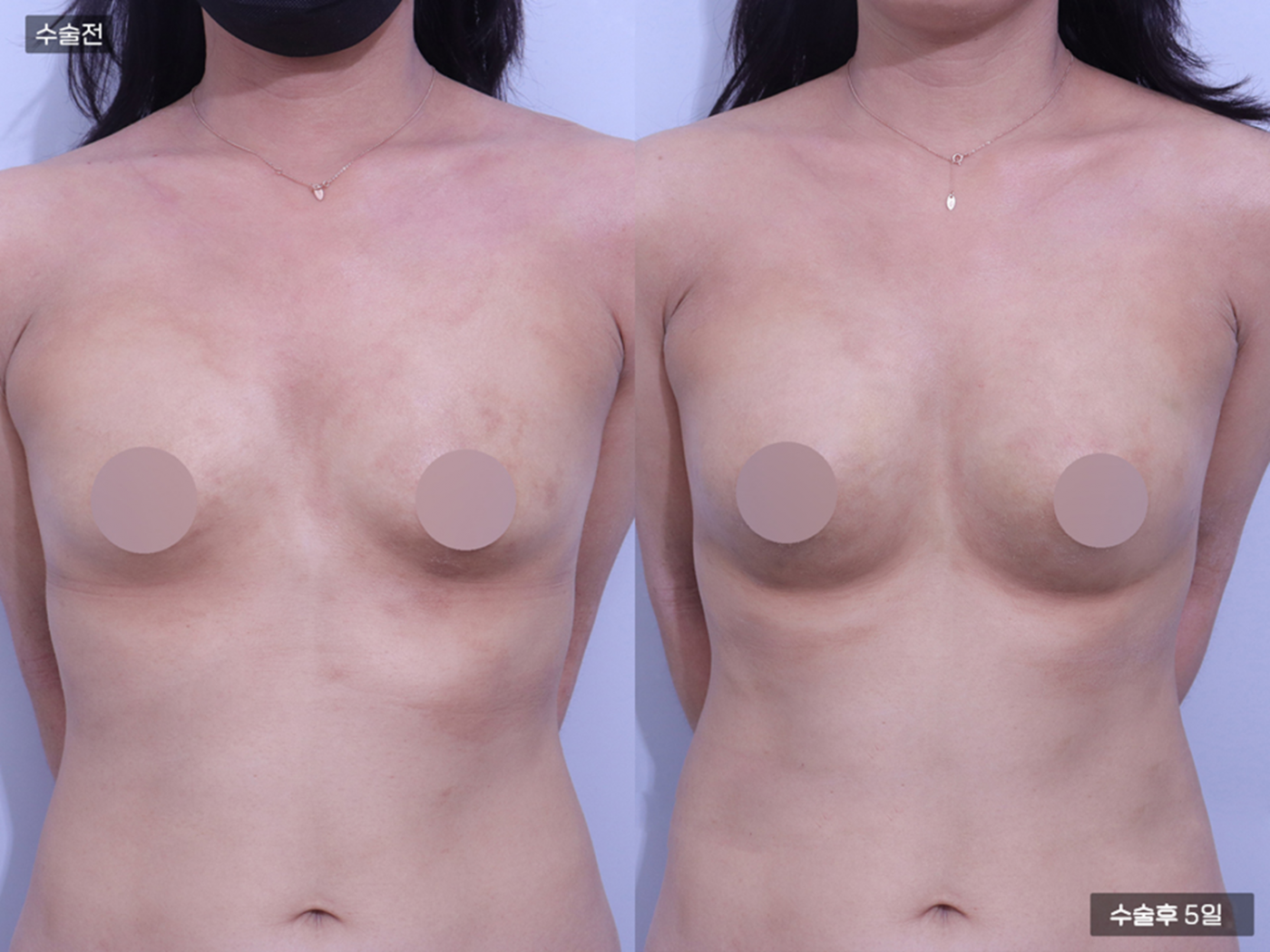 가슴성형 [가슴지방이식(200CC + 200CC)]