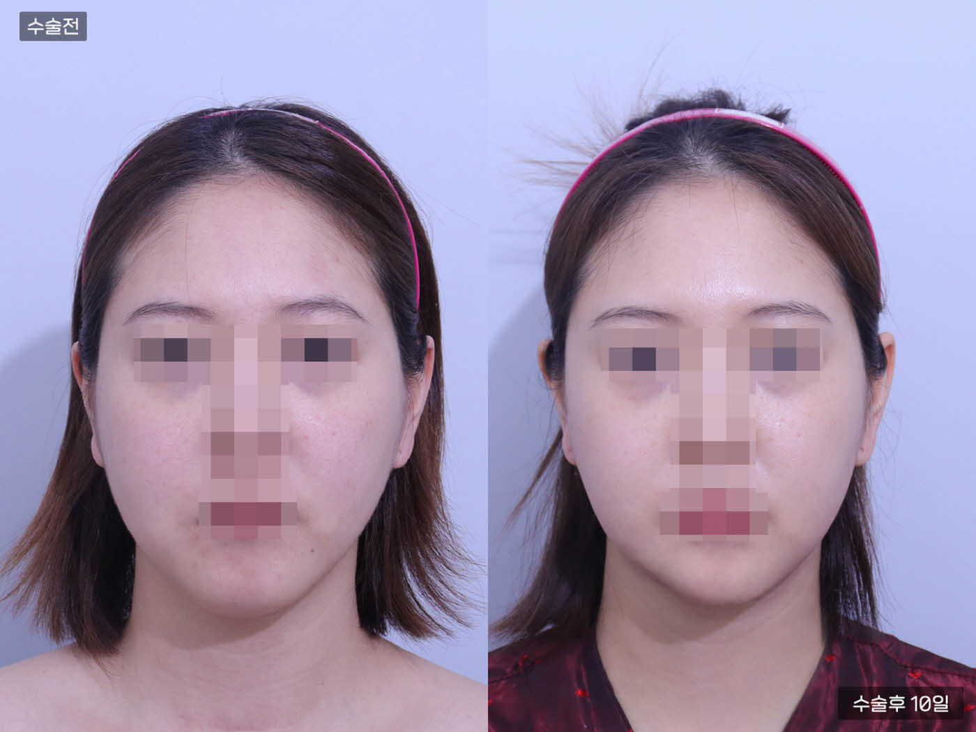 턱 지방흡입[이중턱 지방흡입]