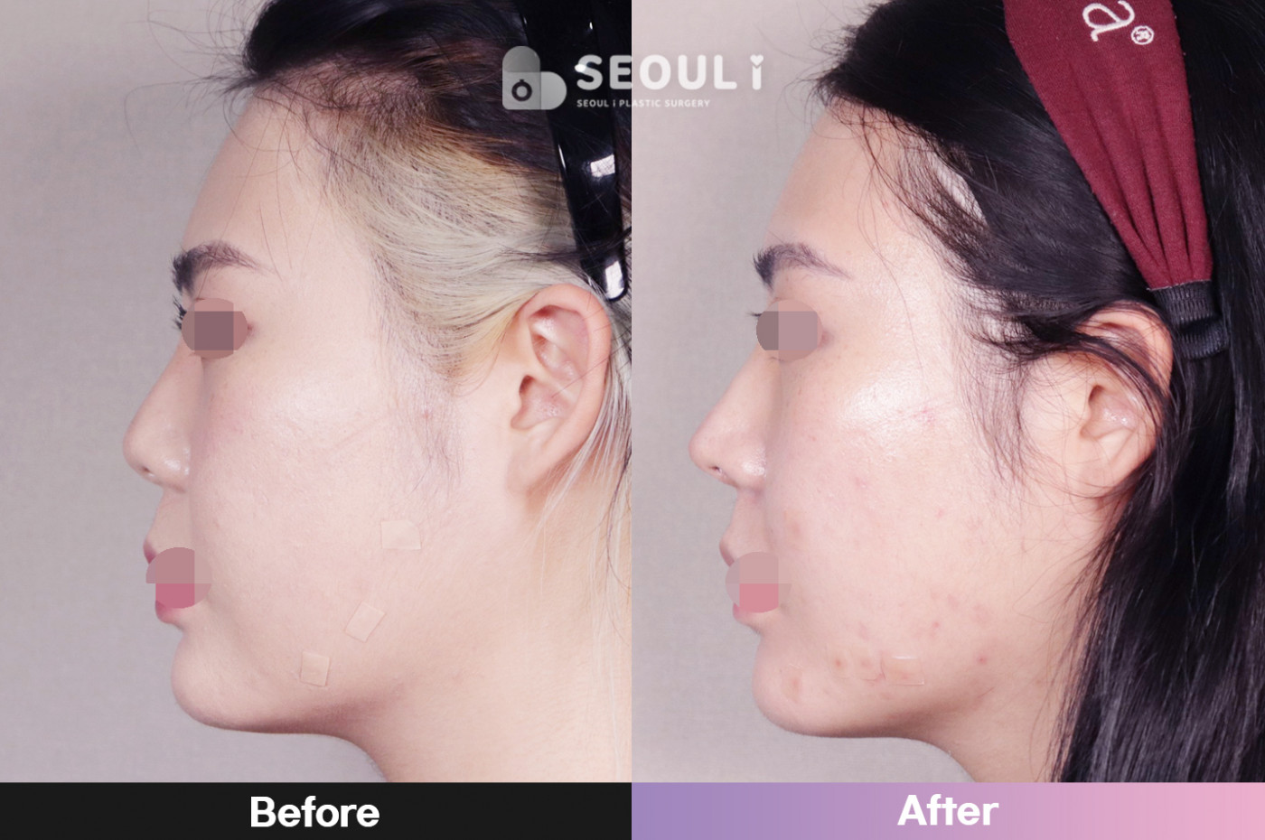 코끝(비중격)+복코+매부리 교정