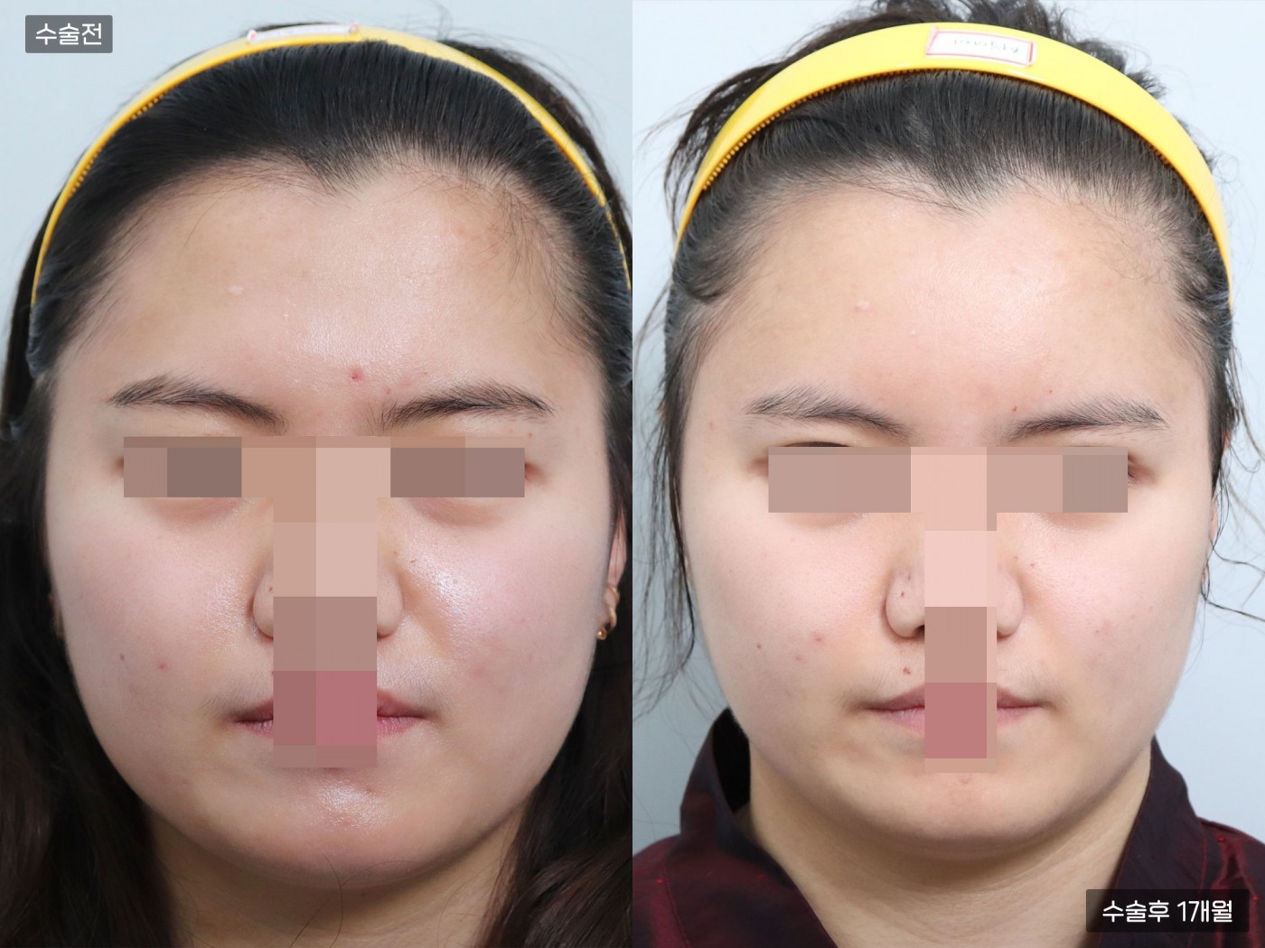 지방이식 [풀페이스]