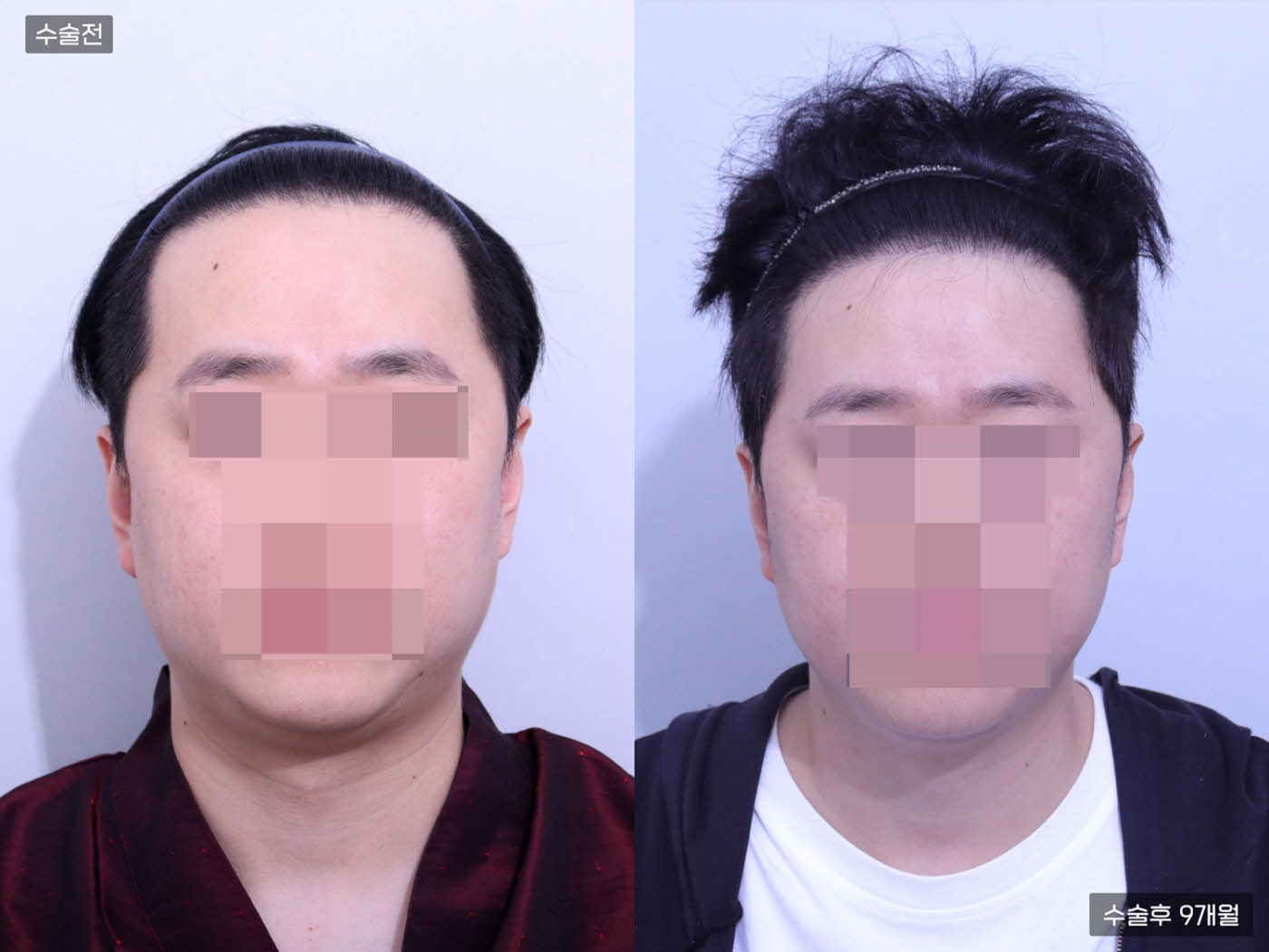 모발이식[비절개 모발이식(4000모)]