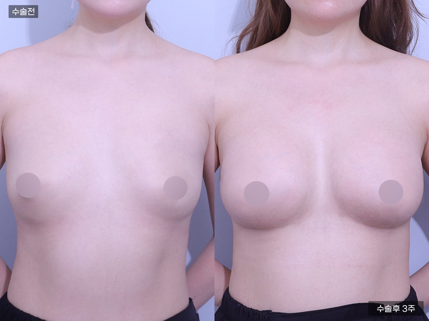 가슴보형물 (300cc +300cc)