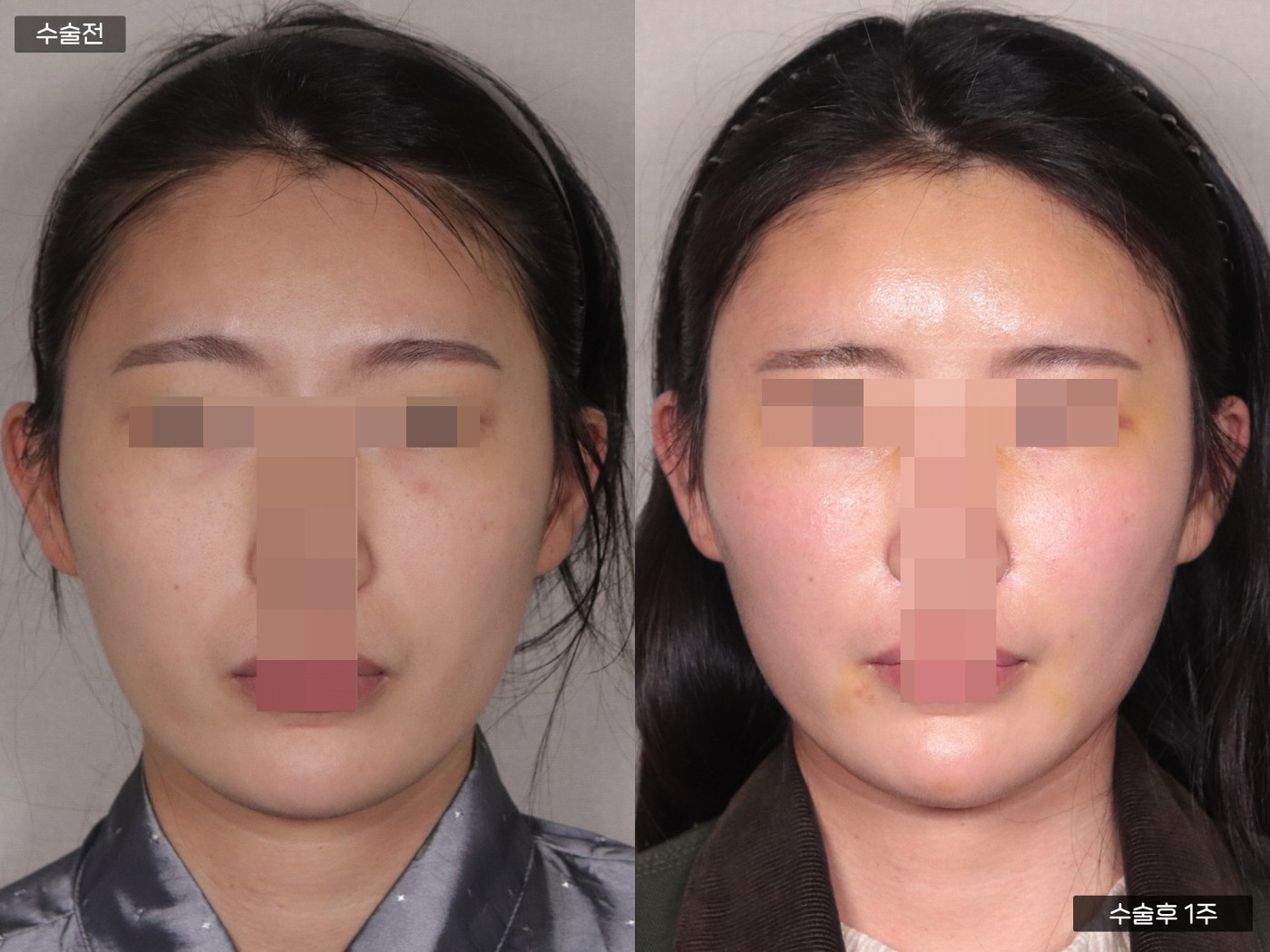 지방이식 [풀페이스]