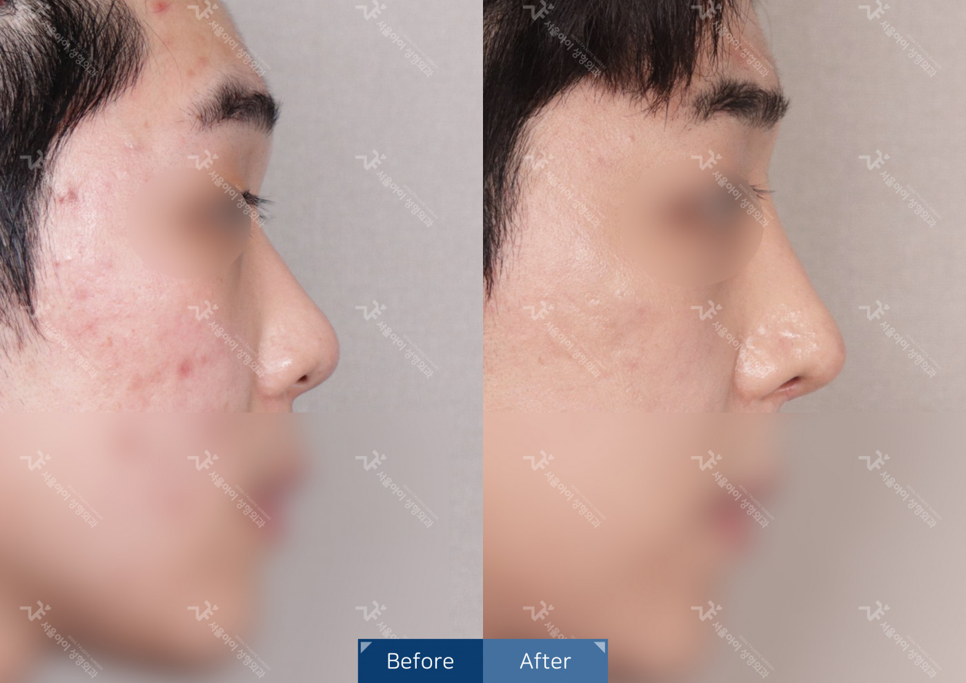 코성형 [융비술&코끝조각술(비중격)+복코교정술+짧은코]